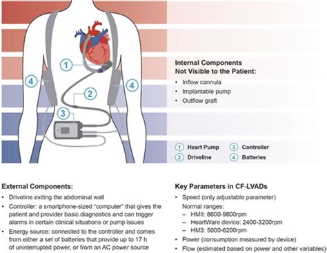 left ventricular heave.